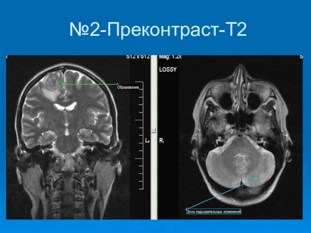 №2-Преконтраст-Т2