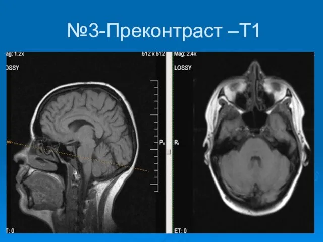 №3-Преконтраст –Т1