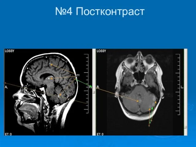 №4 Постконтраст