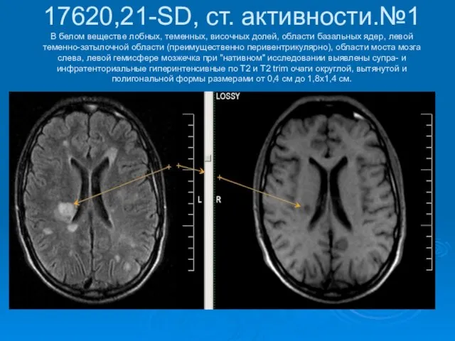 17620,21-SD, ст. активности.№1 В белом веществе лобных, теменных, височных долей, области