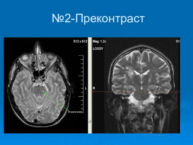 №2-Преконтраст