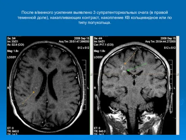 После в/венного усиления выявлено 3 супратенториальных очага (в правой теменной доле),