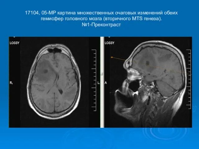17104, 05-МР картина множественных очаговых изменений обеих гемисфер головного мозга (вторичного МТS генеза). №1-Преконтраст