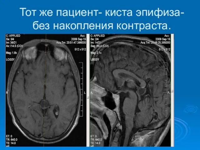 Тот же пациент- киста эпифиза-без накопления контраста.