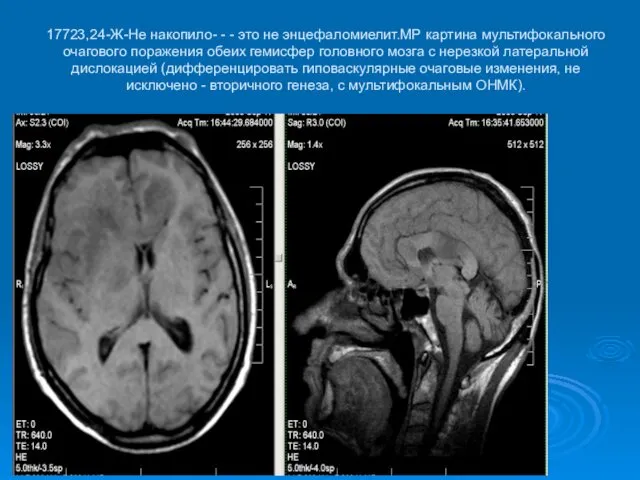 17723,24-Ж-Не накопило- - - это не энцефаломиелит.МР картина мультифокального очагового поражения