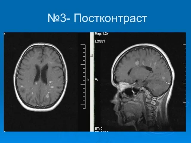 №3- Постконтраст