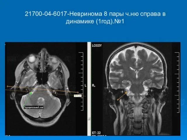 21700-04-6017-Невринома 8 пары ч.ню справа в динамике (1год).№1