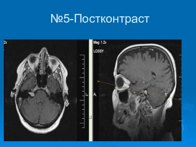 №5-Постконтраст