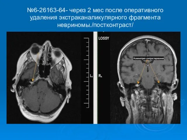 №6-26163-64- через 2 мес после оперативного удаления экстраканаликулярного фрагмента невриномы./постконтраст/