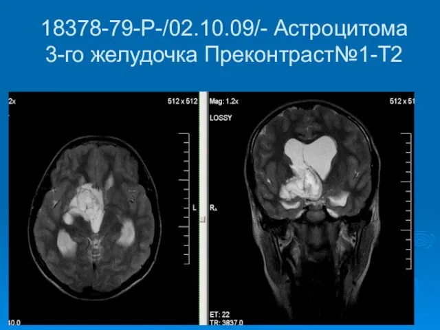 18378-79-Р-/02.10.09/- Астроцитома 3-го желудочка Преконтраст№1-Т2