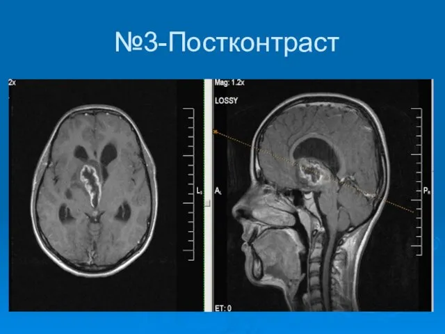 №3-Постконтраст