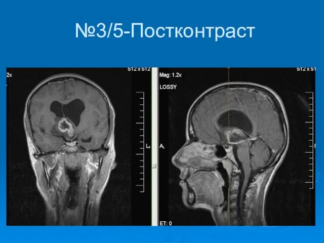 №3/5-Постконтраст