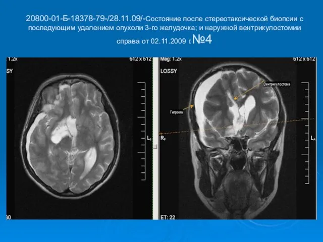 20800-01-Б-18378-79-/28.11.09/-Состояние после стереотаксической биопсии с последующим удалением опухоли 3-го желудочка; и