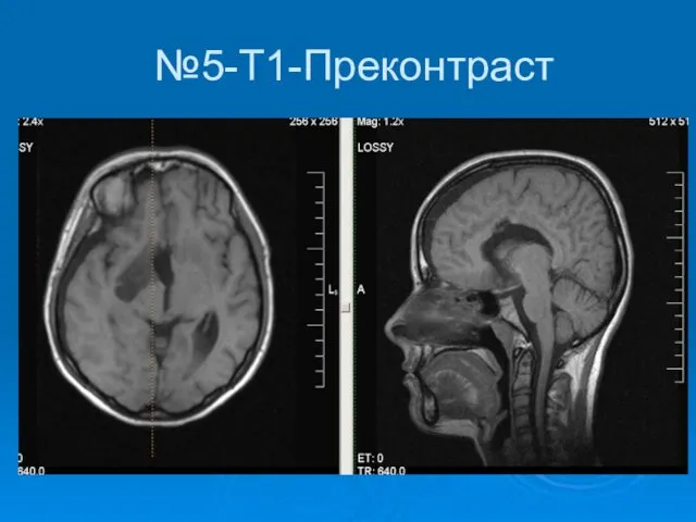 №5-Т1-Преконтраст