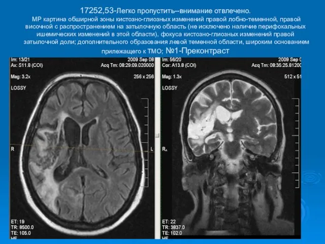 17252,53-Легко пропустить--внимание отвлечено. МР картина обширной зоны кистозно-глиозных изменений правой лобно-теменной,