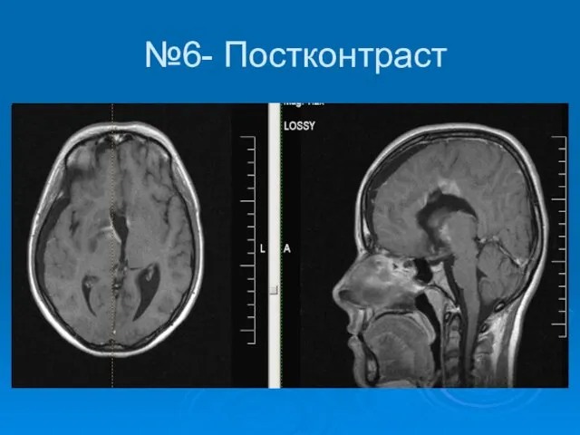 №6- Постконтраст