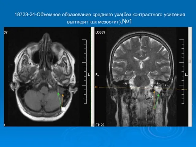 18723-24-Объемное образование среднего уха(без контрастного усиления выглядит как мезоотит).№1