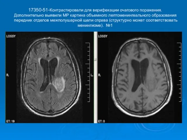 17350-51-Контрастировали для верифекации очагового поражения. Дополнительно выявили МР картина объемного лептоменингеального