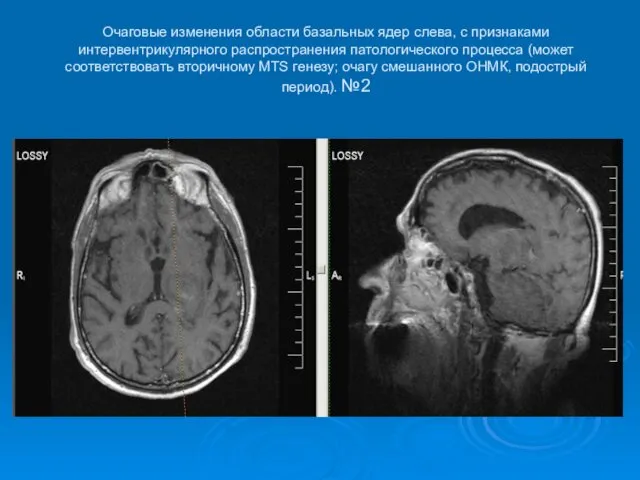 Очаговые изменения области базальных ядер слева, с признаками интервентрикулярного распространения патологического