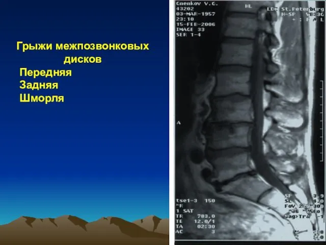 Грыжи межпозвонковых дисков Передняя Задняя Шморля