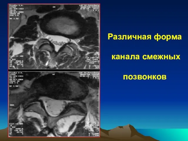 Различная форма канала смежных позвонков