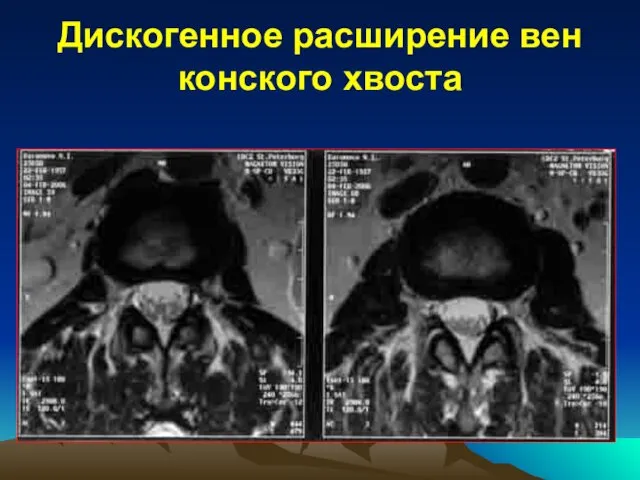 Дискогенное расширение вен конского хвоста