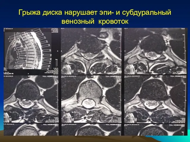 Грыжа диска нарушает эпи- и субдуральный венозный кровоток