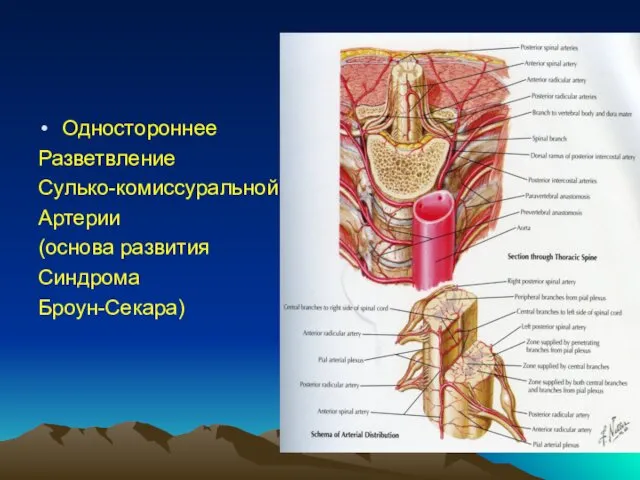 Одностороннее Разветвление Сулько-комиссуральной Артерии (основа развития Синдрома Броун-Секара)