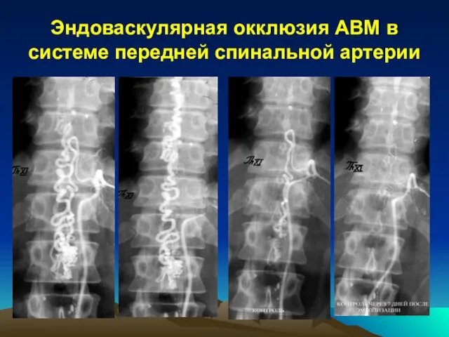 Эндоваскулярная окклюзия АВМ в системе передней спинальной артерии