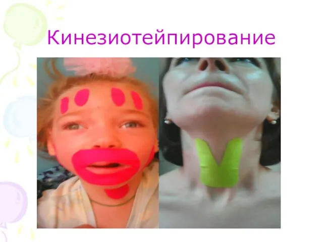 Кинезиотейпирование