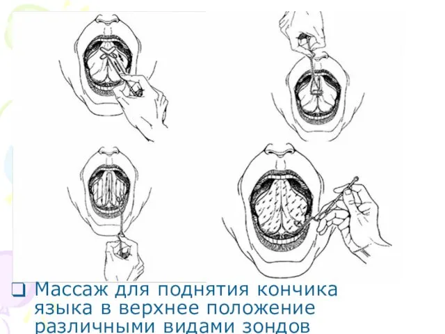 Массаж для поднятия кончика языка в верхнее положение различными видами зондов