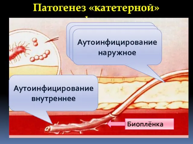 Патогенез «катетерной» инфекции Руки персонала Средства для дезинфекции Аутоинфицирование наружное Аутоинфицирование внутреннее Биоплёнка