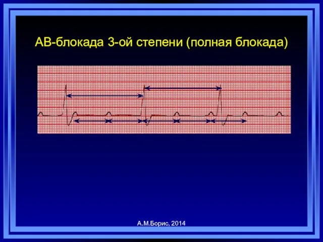 А.М.Борис, 2014 АВ-блокада 3-ой степени (полная блокада)
