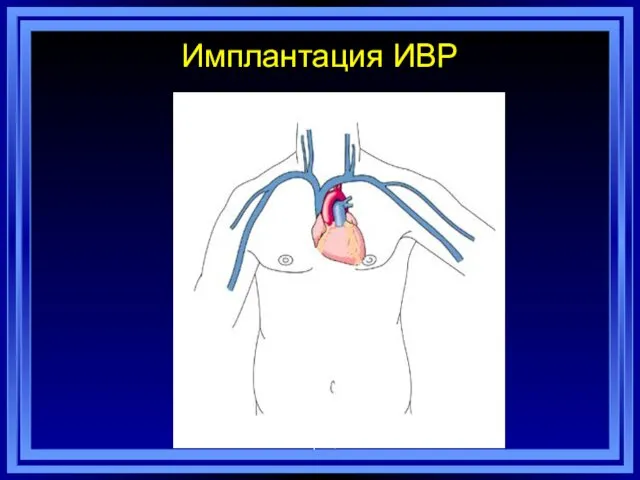 Имплантация ИВР А.М.Борис, 2014