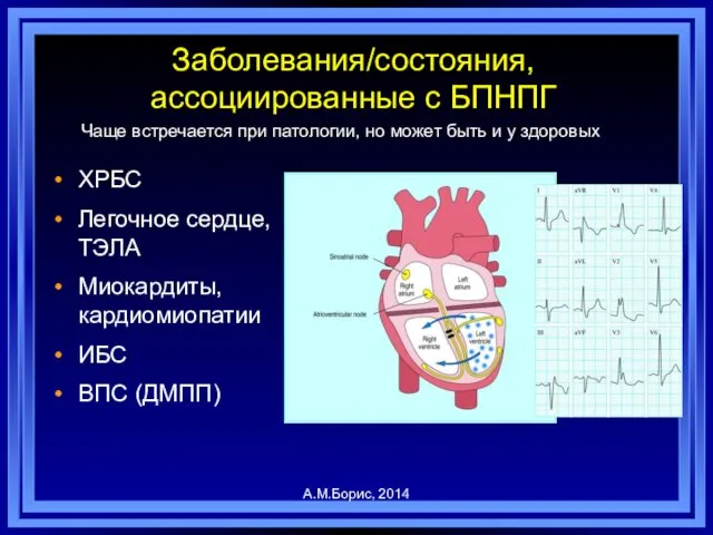 Заболевания/состояния, ассоциированные с БПНПГ ХРБС Легочное сердце, ТЭЛА Миокардиты, кардиомиопатии ИБС