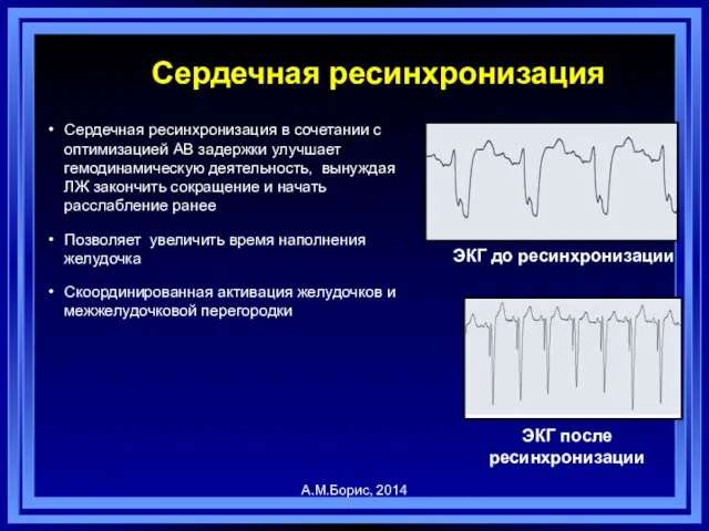 Сердечная ресинхронизация Сердечная ресинхронизация в сочетании с оптимизацией АВ задержки улучшает