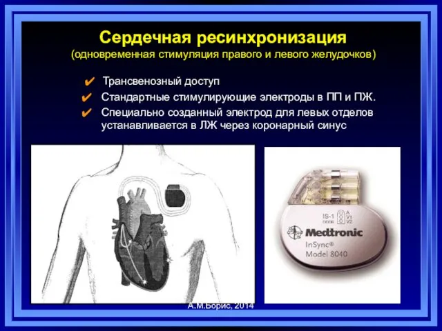 Трансвенозный доступ Стандартные стимулирующие электроды в ПП и ПЖ. Специально созданный