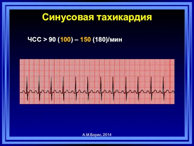 Синусовая тахикардия ЧСС > 90 (100) – 150 (180)/мин А.М.Борис, 2014