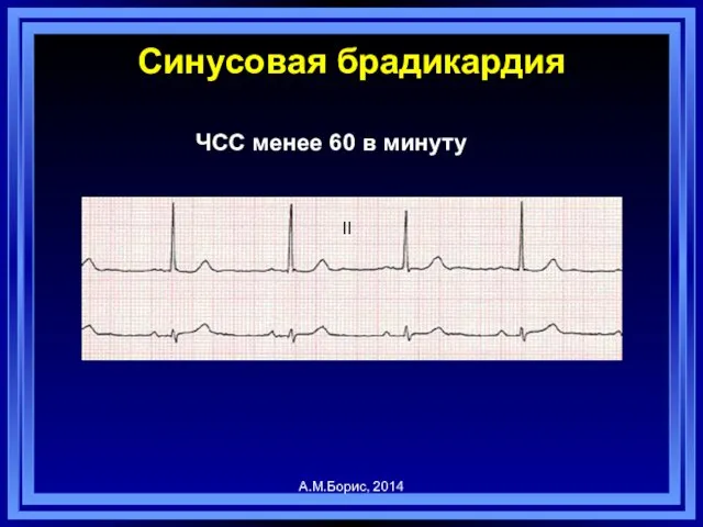 Синусовая брадикардия ЧСС менее 60 в минуту А.М.Борис, 2014 II