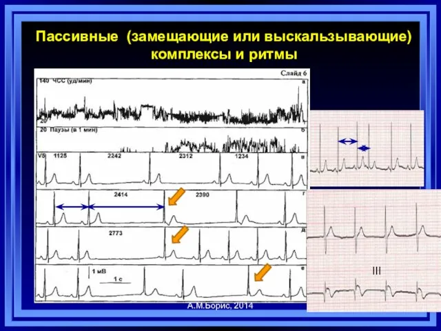 А.М.Борис, 2014 Пассивные (замещающие или выскальзывающие) комплексы и ритмы III