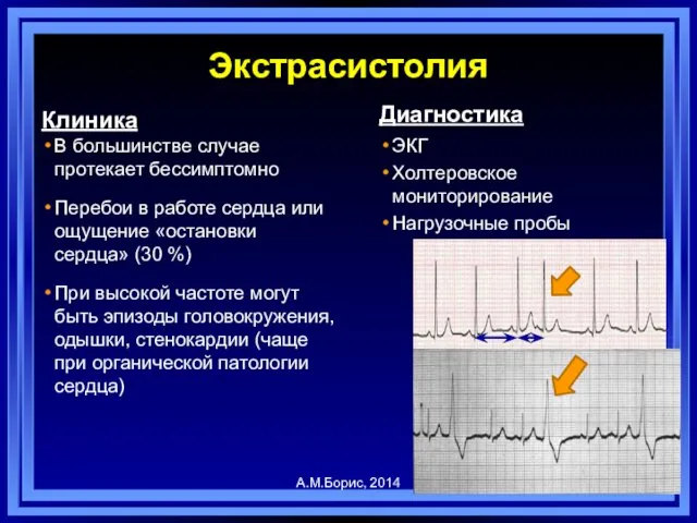 Экстрасистолия Клиника В большинстве случае протекает бессимптомно Перебои в работе сердца