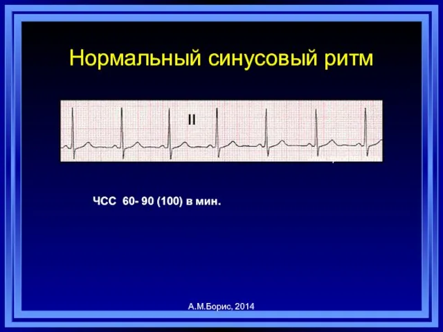 Нормальный синусовый ритм ЧСС 60- 90 (100) в мин. www.uptodate.com II А.М.Борис, 2014