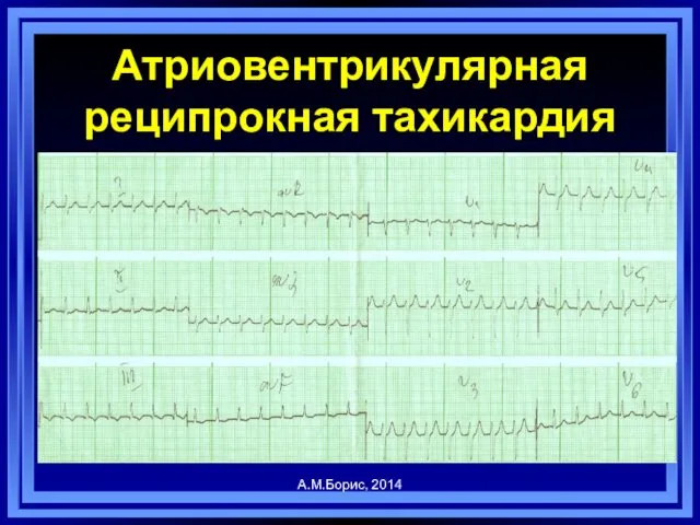 Атриовентрикулярная реципрокная тахикардия А.М.Борис, 2014