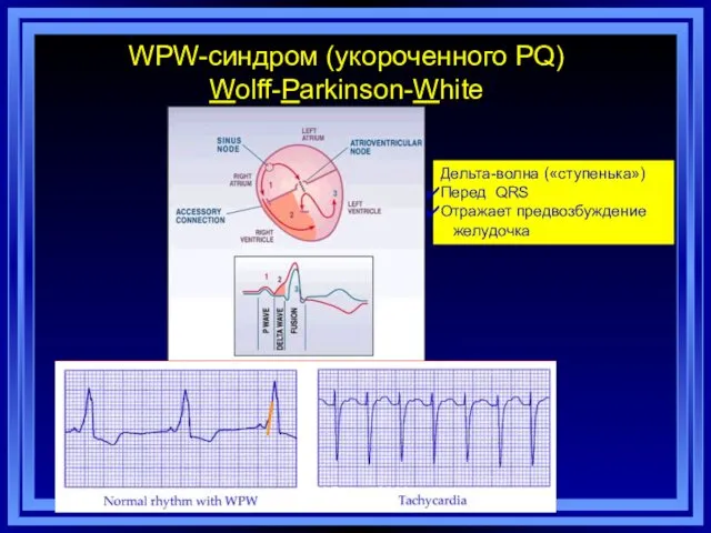 WPW-синдром (укороченного PQ) Wolff-Parkinson-White Дельта-волна («ступенька») Перед QRS Отражает предвозбуждение желудочка А.М.Борис, 2014