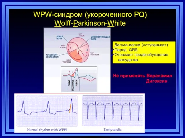 WPW-синдром (укороченного PQ) Wolff-Parkinson-White Дельта-волна («ступенька») Перед QRS Отражает предвозбуждение желудочка