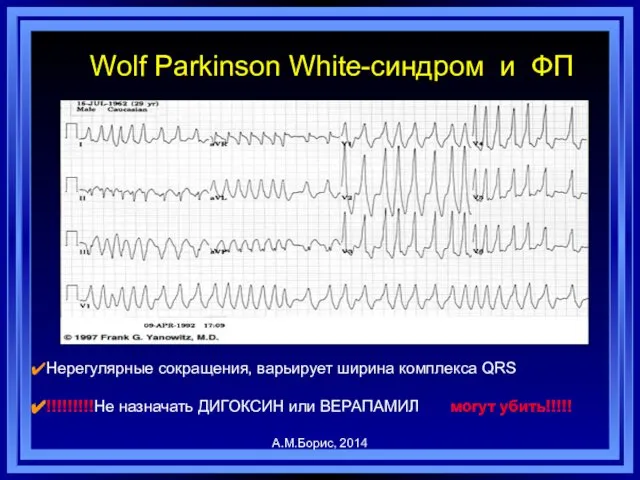 Нерегулярные сокращения, варьирует ширина комплекса QRS !!!!!!!!!Не назначать ДИГОКСИН или ВЕРАПАМИЛ