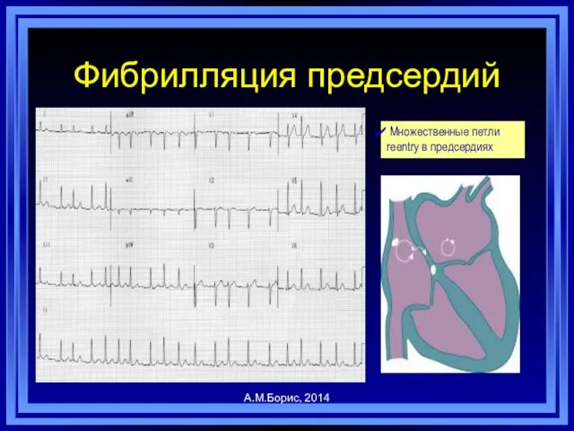 Фибрилляция предсердий А.М.Борис, 2014 Множественные петли reentry в предсердиях