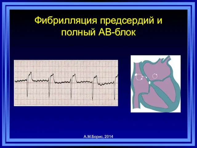 А.М.Борис, 2014 Фибрилляция предсердий и полный АВ-блок