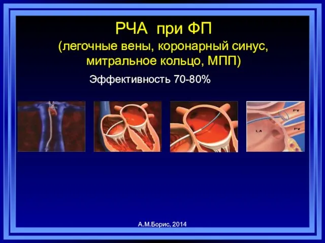 РЧА при ФП (легочные вены, коронарный синус, митральное кольцо, МПП) Эффективность 70-80% А.М.Борис, 2014