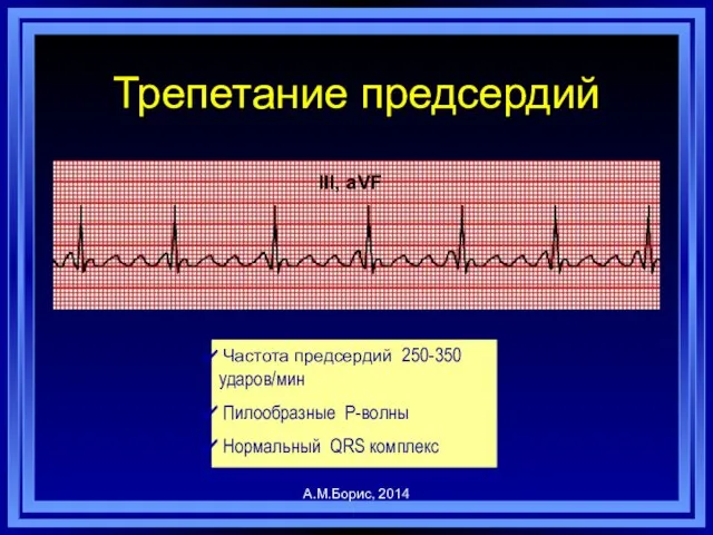 Трепетание предсердий Частота предсердий 250-350 ударов/мин Пилообразные P-волны Нормальный QRS комплекс А.М.Борис, 2014 III, aVF